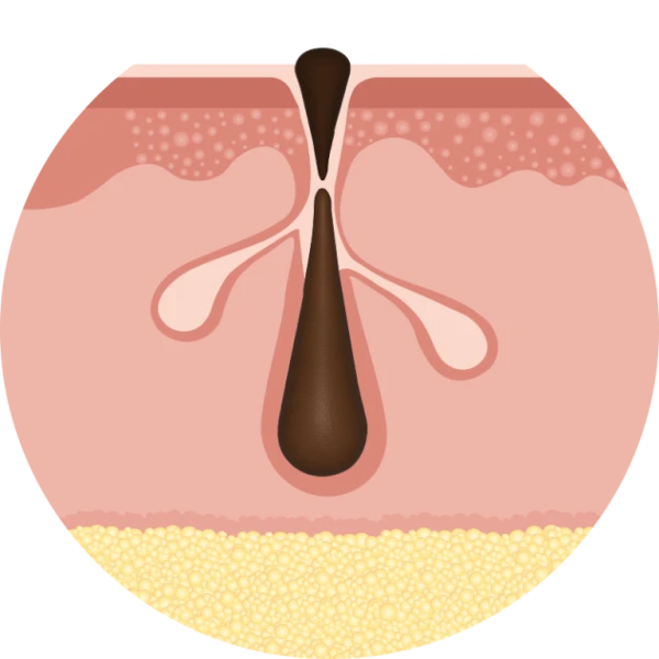 Acne nijkerk