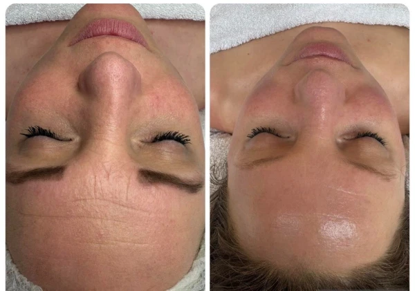 anit-aging voor en na 