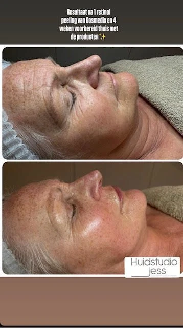 anit-aging voor en na 